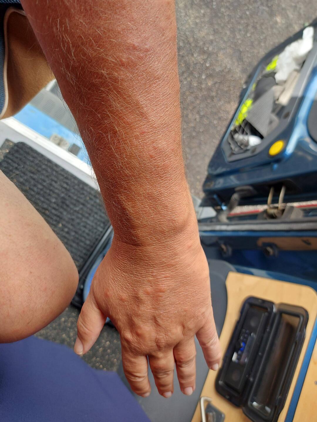 Arm und Hand und alles brennt und auf keinen Fall kratzen.