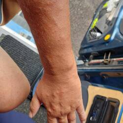 Arm und Hand und alles brennt und auf keinen Fall kratzen.
