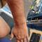 Arm und Hand und alles brennt und auf keinen Fall kratzen.