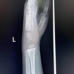 Felix Handgelenk nach dem Trampolin