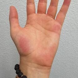 Die letzten Spuren vom Surfbrett... Meine Fingerkuppen sind jetzt auch komplett glatt 😂 Bankraub..?