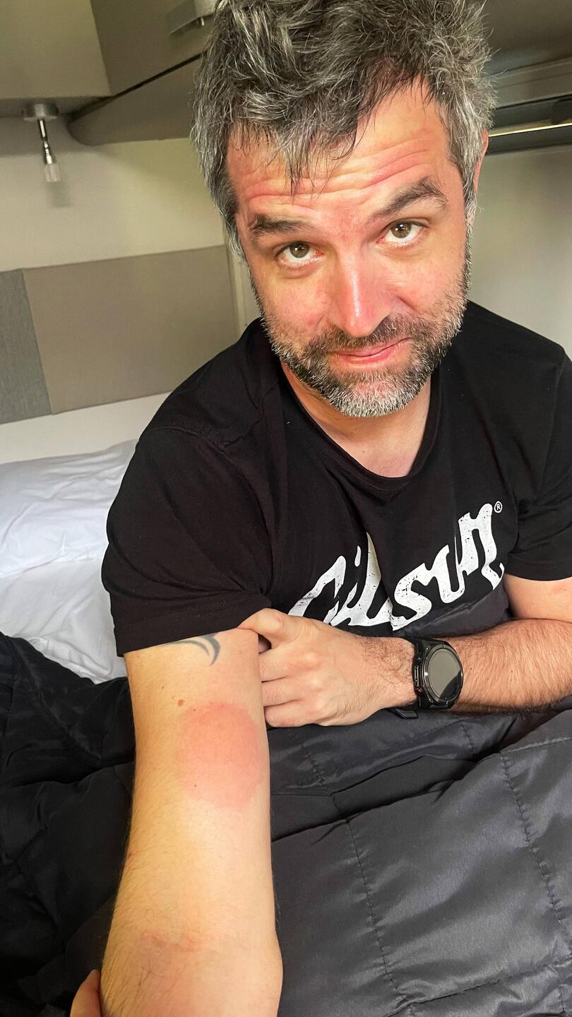 Sandfly-Stiche! Man beachte, die Biester sind ca. 2mm gross..