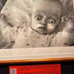 Un bébé né avec une malformation en 2000 !