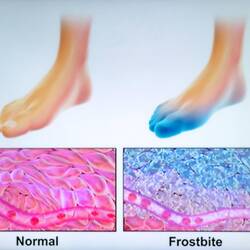 Frostbite is an injury caused by freezing of the skin and underlying tissues ... Dr Amar's lecture.