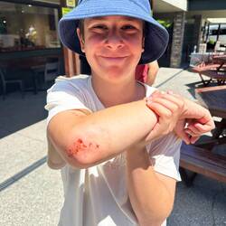 Das Sturz Souvenir dass Janosch (mit einem Lächeln) mitgenommen hat