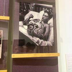 Painting her cast after spinal surgery