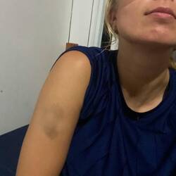 Arm, Rippe, Hüfte und Finger mussten leiden.