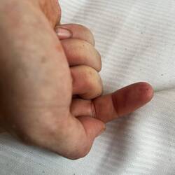 Black Sea urchin spike removal, circa 3,5 hour project (12 spikes)