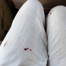 The aftermath of tsetse fly attacks