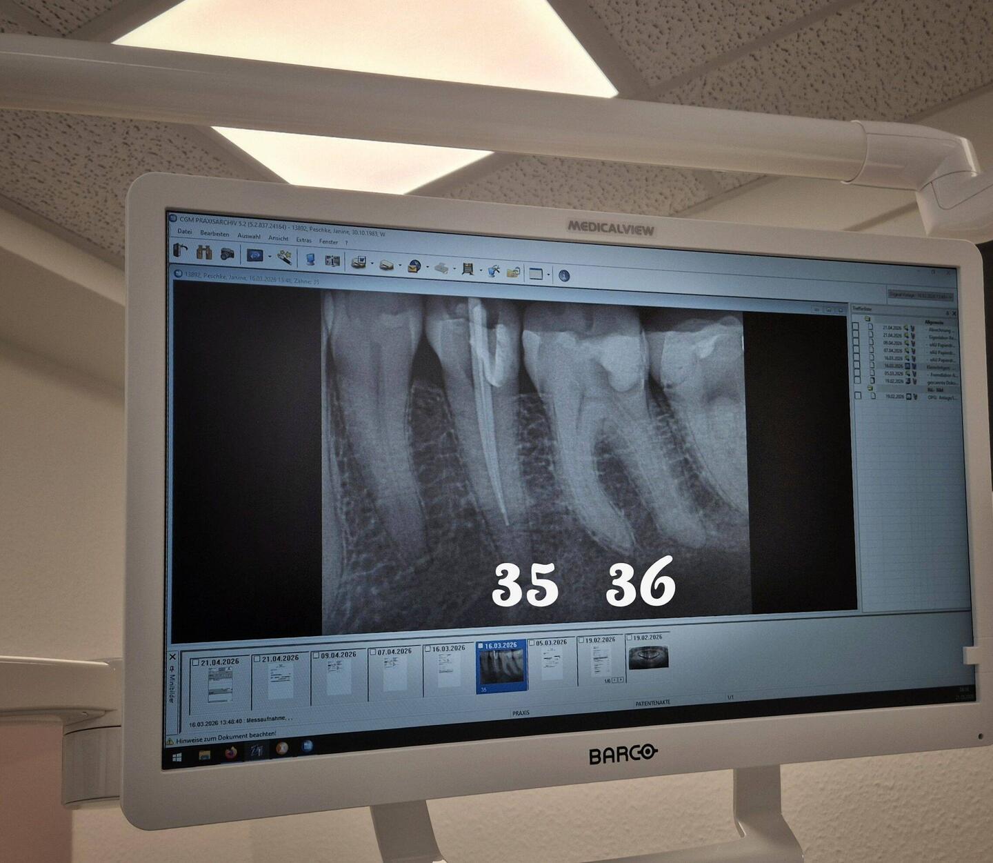 Röntgenbild nach 2. Wurzelkanalbehandlung vom 🦷´35 am 16.03.2026 - noch vor Behandlung des 🦷´36
