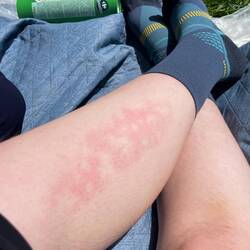 My leg looking like the blood inside is boiling