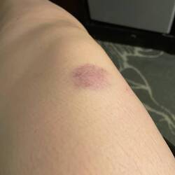 das lila-blaue Knie, danke an den Busfahrer!