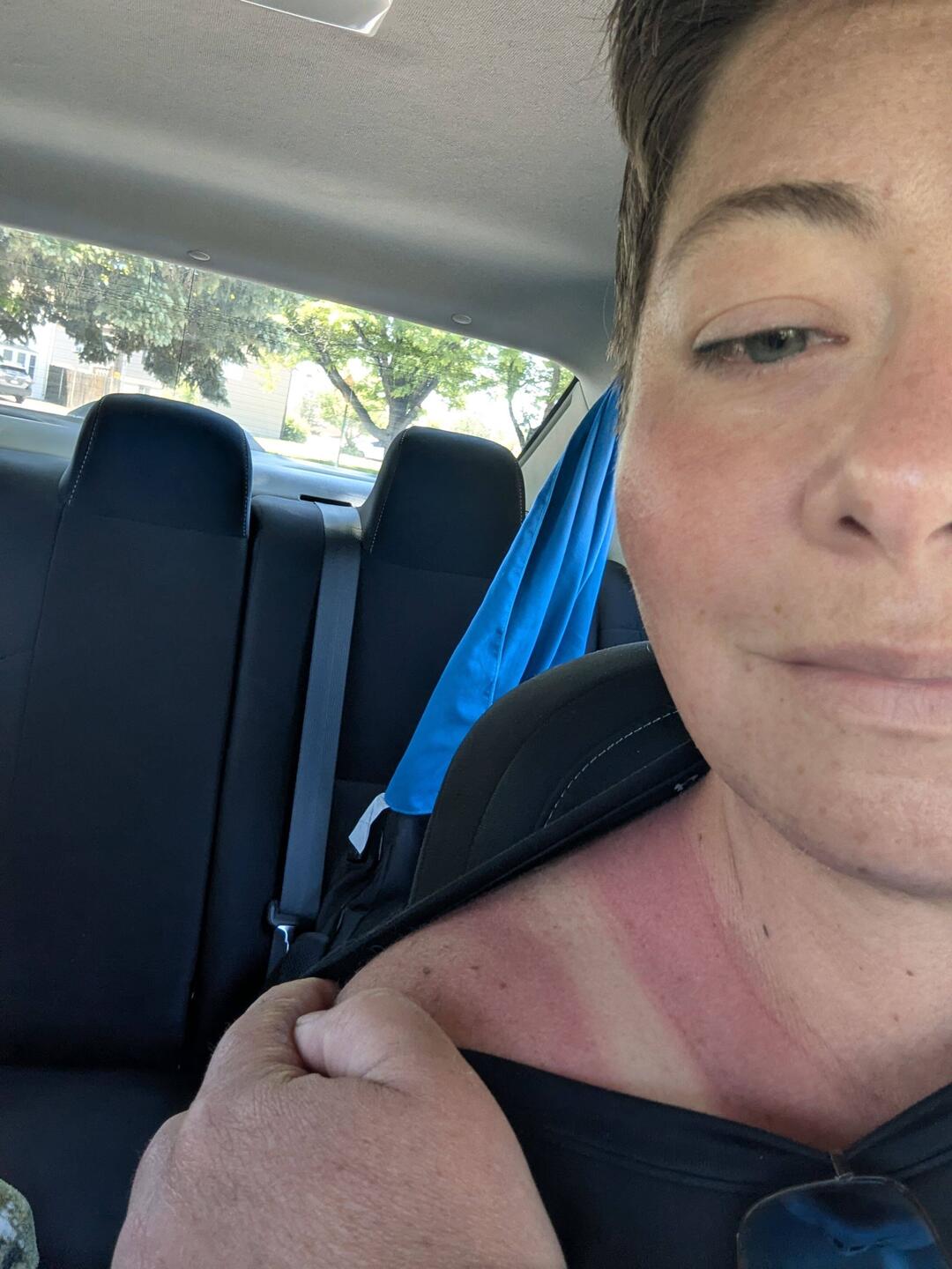 My sunburn was a little worse than I thought at first. Waiting to see if I peel