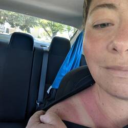 My sunburn was a little worse than I thought at first. Waiting to see if I peel