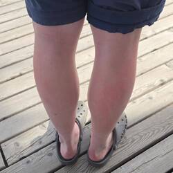 Hier nicht gut zu erkennen, aber im Selbstest bewiesen: Sonnencreme wirkt. Nur wo man sie nutzt...