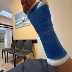 Erst der Gips....