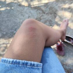 Blessure de guerre