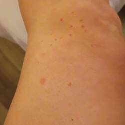 Chiggers. Oh well. They'll die eventually. Just don't scratch!